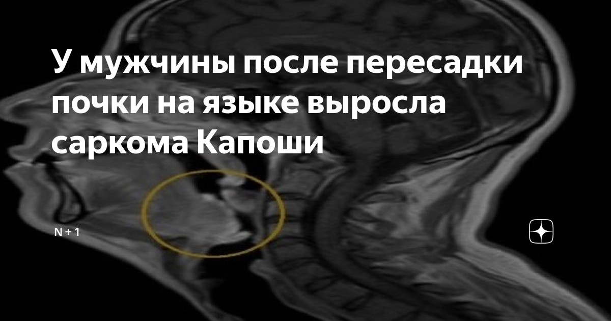 У мужчины после пересадки почки на языке выросла саркома Капоши | N + 1 ...