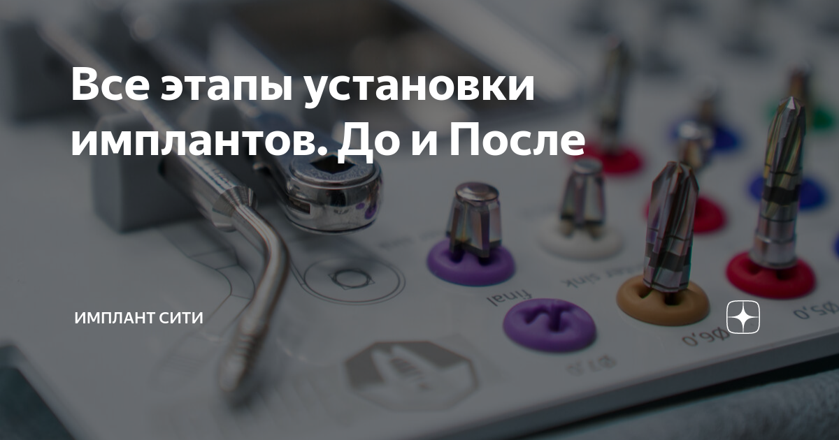 Все этапы установки имплантов. До и После | Имплант Сити | Дзен