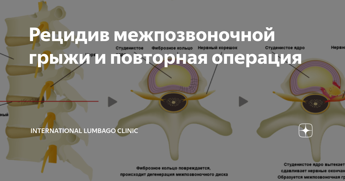 межпозвоночная грыжа операция цена москва