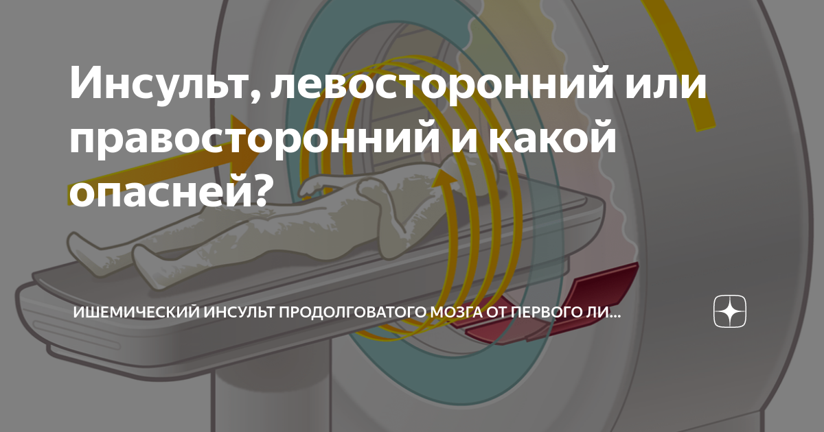 сколько живут после левостороннего инсульта
