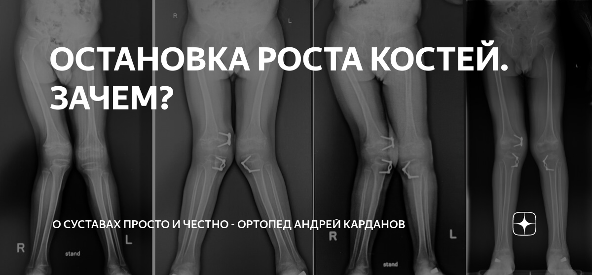 ОСТАНОВКА РОСТА КОСТЕЙ. ЗАЧЕМ? | О СУСТАВАХ ПРОСТО И ЧЕСТНО - ортопед ...