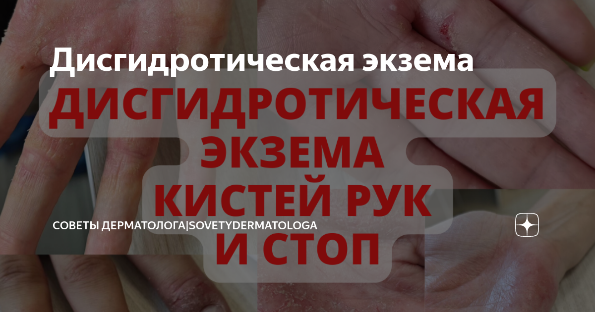 Дисгидротическая экзема | Советы дерматолога|Sovetydermatologa | Дзен