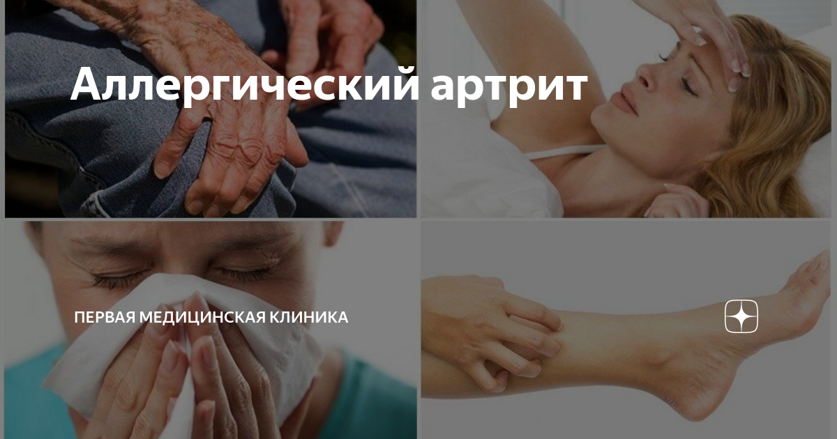 Аллергический артрит у детей лечение. Вирусный артрит: симптомы и лечение у детей и взрослых Аллергический артрит: причины, симптомы и лечение Аллергический артрит: симптомы и особенности лечения