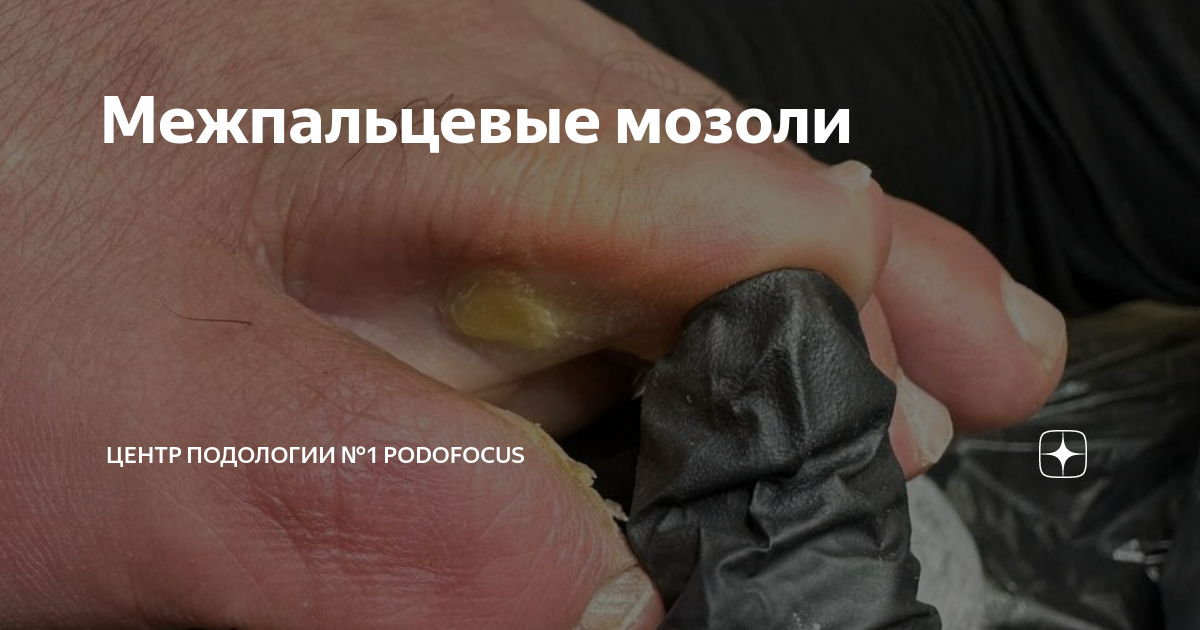 Межпальцевые мозоли | Центр подологии №1 PodoFocus | Дзен
