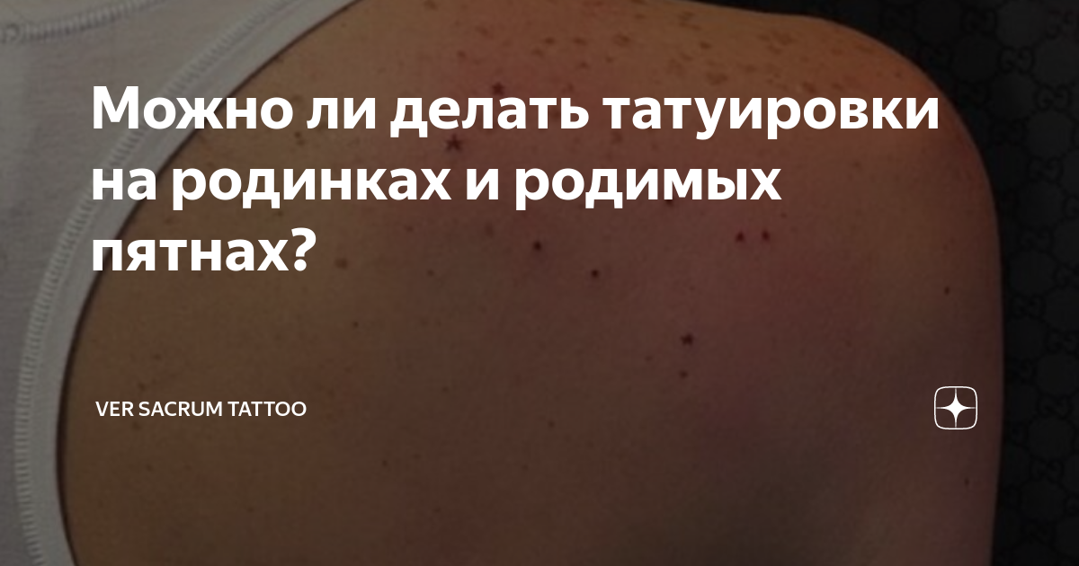 Можно ли делать тату на коже с акне, витилиго, родинками, родимыми пятнами? | iNKPPL