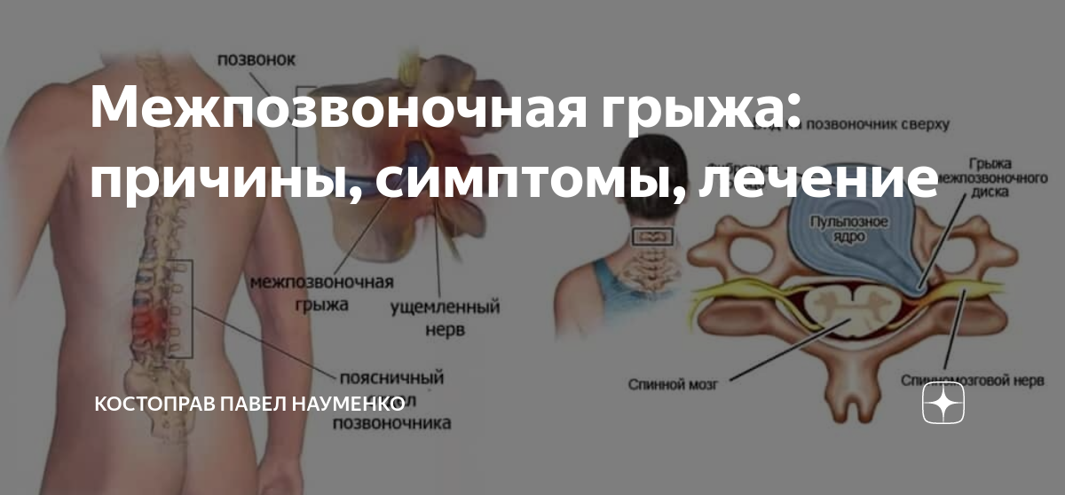 Лечение грыжи казань