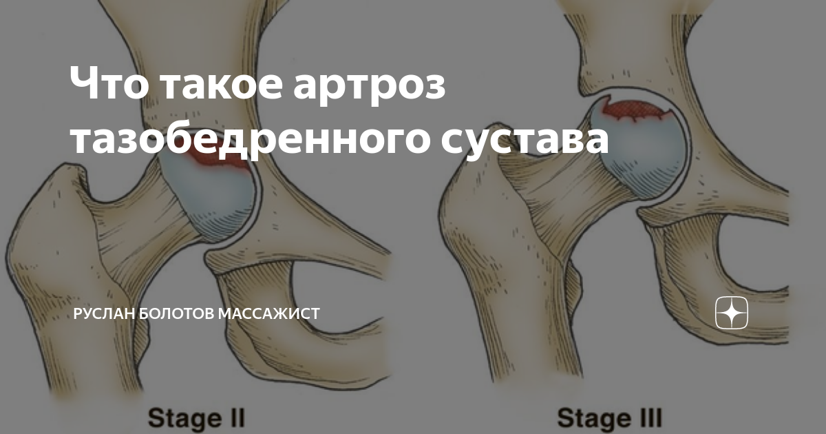 Артроз тазобедренного сустава фото. АРТРОЗ ТАЗОБЕДРЕННОГО СУСТАВА. СИМПТОМЫ И ДИАГНОСТИКА. (Часть 1) Артроз тазобедренного сустава (коксартроз): симптомы и лечение в Центре. 🦵 Что такое коксартроз (артроз тазобедренного сустава)? Что такое коксартроз. 18+