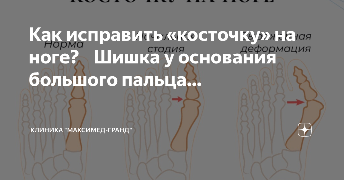 Шишка на ноге у большого пальца . чем лечить. Шишки на ногах у большого пальца – что это такое и как лечить? Косточка на большом пальце ноги: лечение в домашних условиях, операция. Шишка на ноге возле большого пальца: причины, лечение, фото