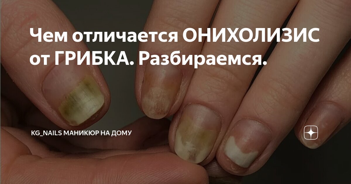 Онихолизис что это Онихолизис что это