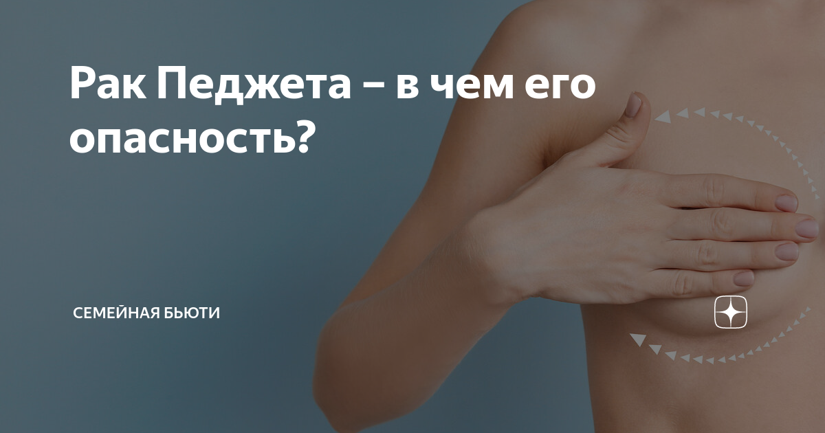 Рак соска фото начальная стадия