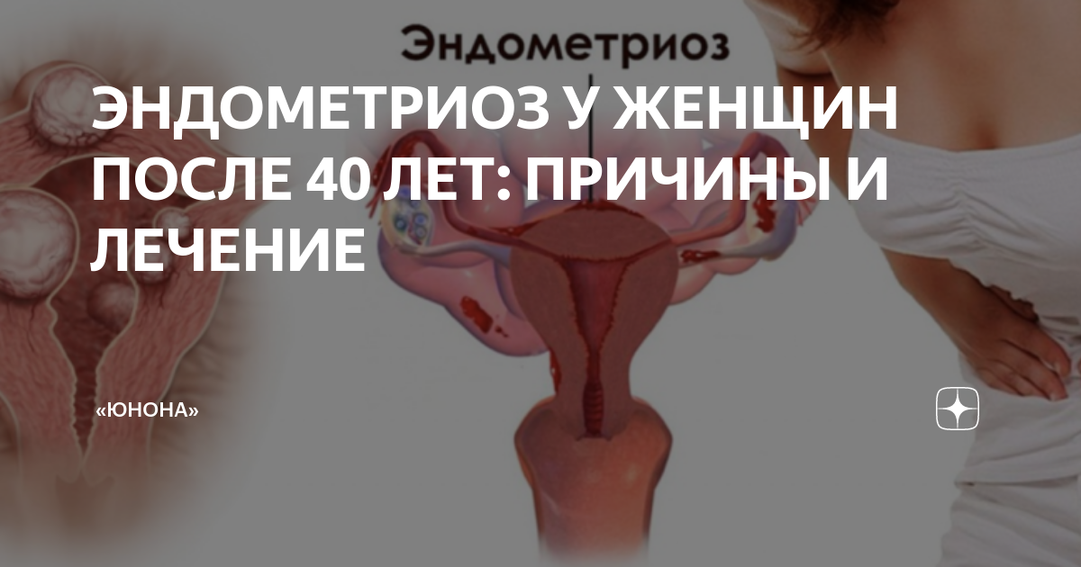 ЭНДОМЕТРИОЗ У ЖЕНЩИН ПОСЛЕ 40 ЛЕТ: ПРИЧИНЫ И ЛЕЧЕНИЕ | «ЮНОНА» | Дзен