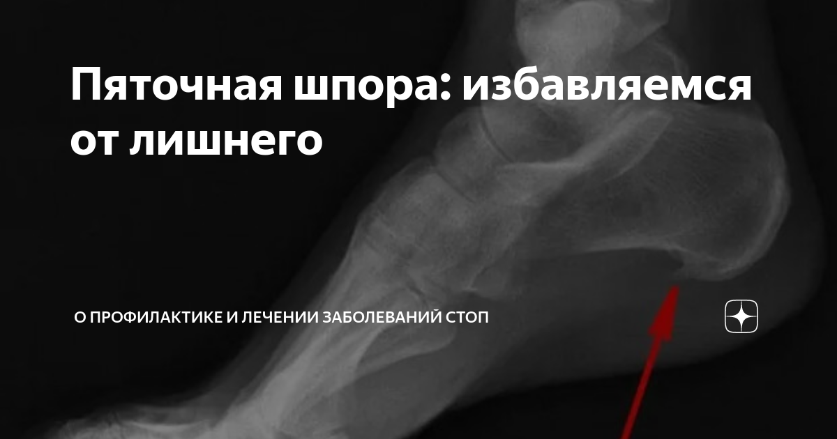 Пяточная шпора: избавляемся от лишнего | Формтотикс | Индивидуальные ...