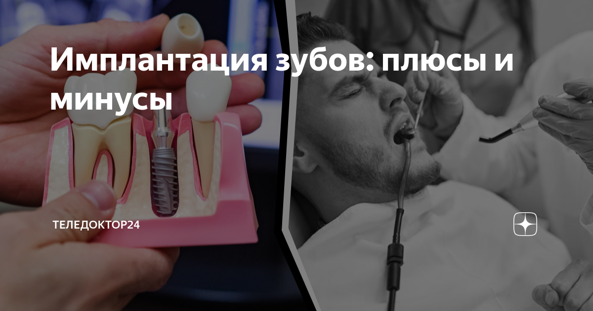Имплантация зубов: плюсы и минусы | Теледоктор24 | Дзен