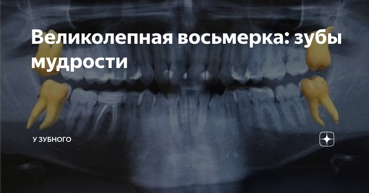Мудрости верхнего. Ретинированный верхний зуб мудрости. Зуб мудрости на верхней челюсти. Зуб мудрости на верхней челюсти. Рентген зубов мудрости.
