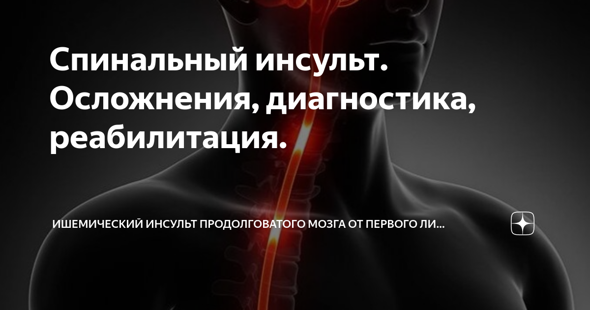 Спинальный инсульт что это симптомы и лечение. Спинальный инсульт. Ишемический спинальный инсульт. Инсульт спинного мозга. Ишемический инсульт спинного мозга.