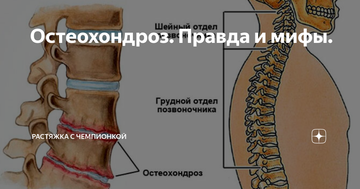 Симптомы поясничного остеохондроза у женщин