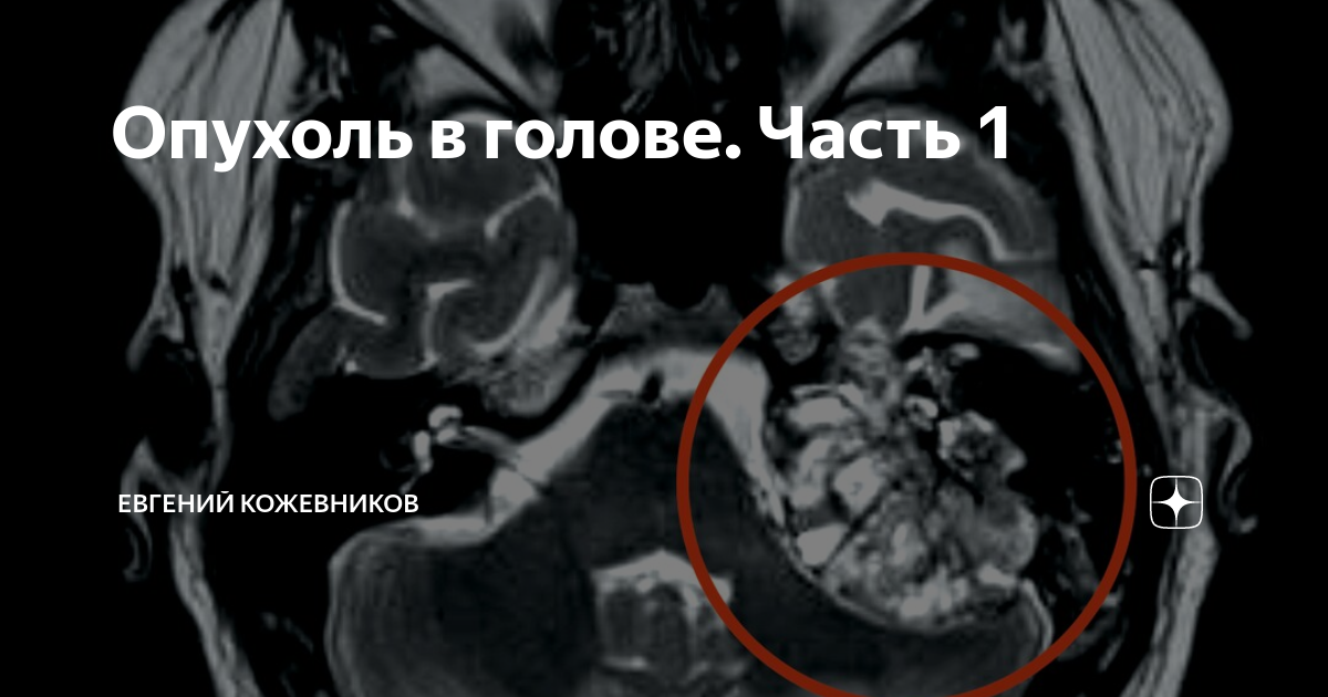 Опухоль в голове. Часть 1 | Евгений Кожевников – Пациент и не только | Дзен