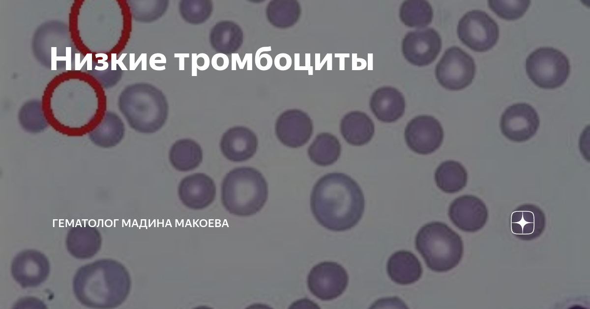 Низкий уровень тромбоцитов? Риски и способы лечения