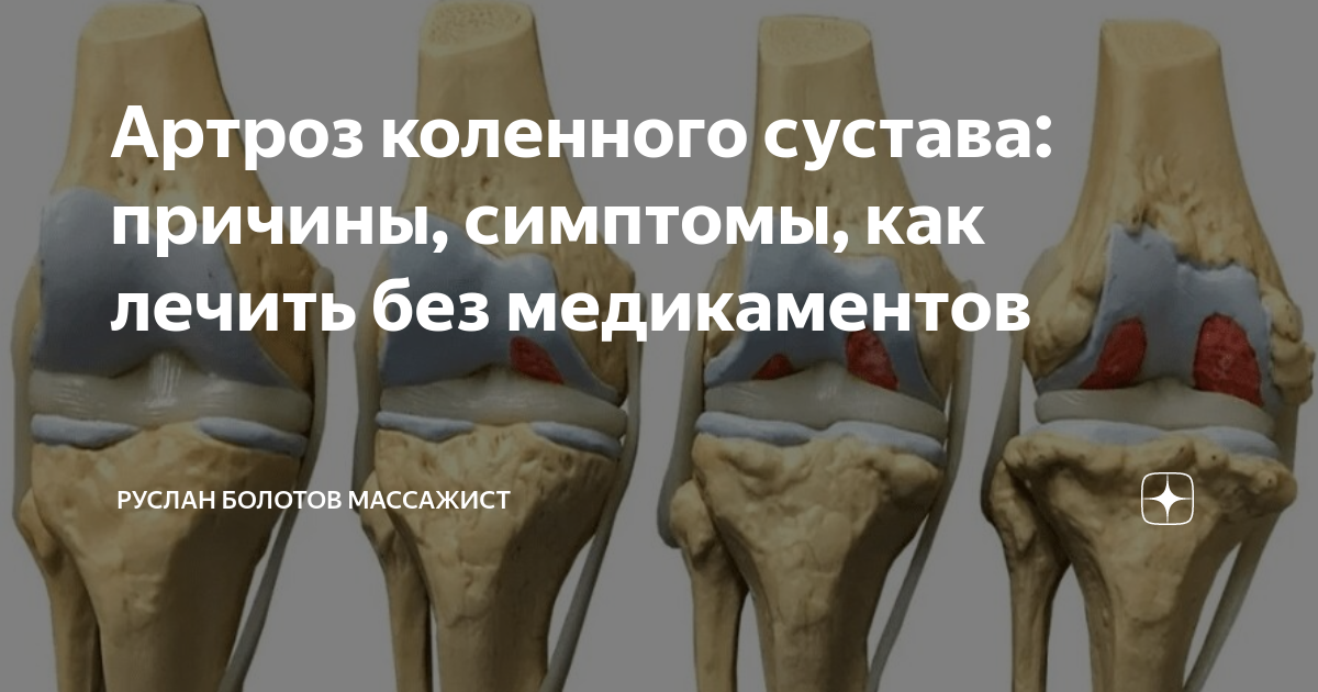 Артроз коленных суставов 3 ст