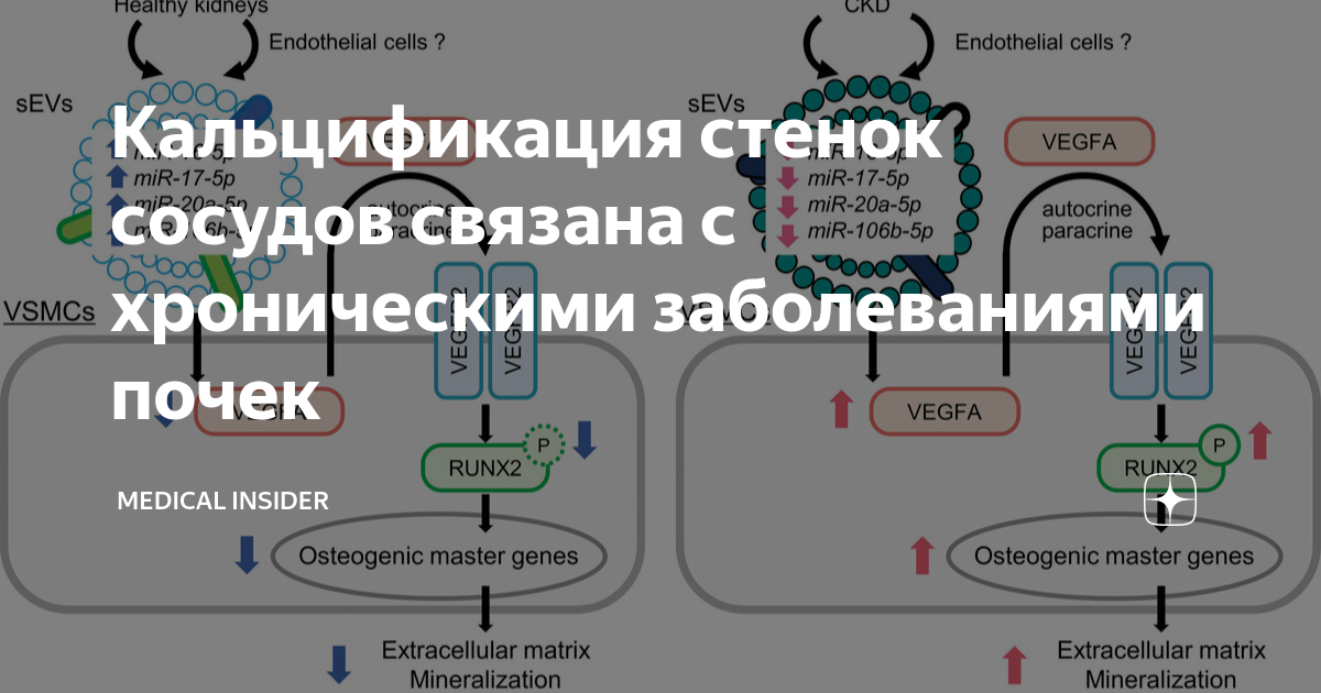 кальциноз почек что это