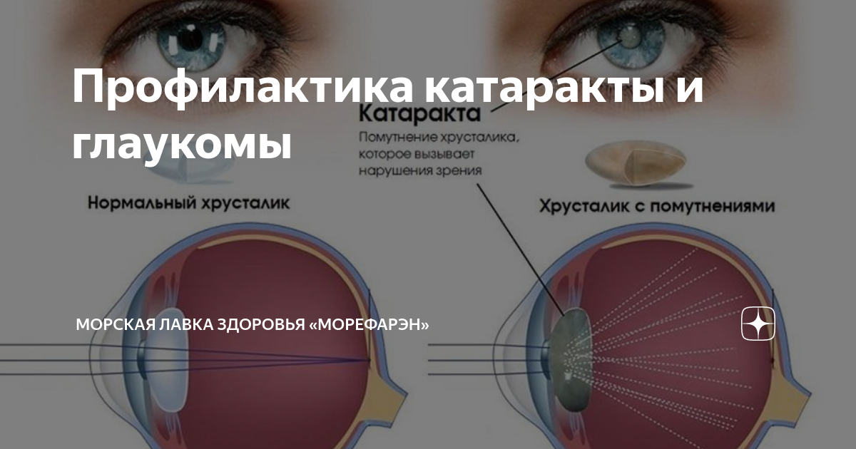 Профилактика катаракты и глаукомы | Морская Лавка Здоровья «МореФарэн ...