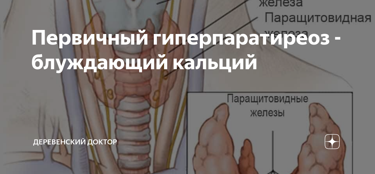 Первичный гиперпаратиреоз - блуждающий кальций | Деревенский доктор | Дзен