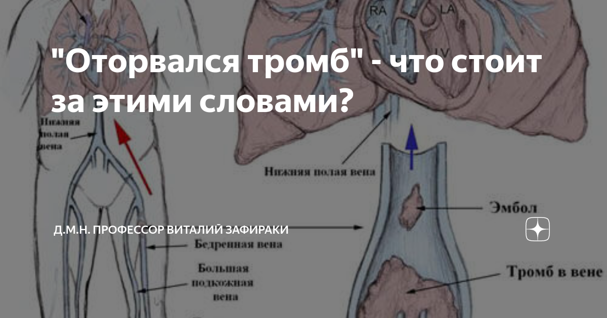 Оторвался тромб в легких. Тромб оторвался смерть. Покойник оторвался тромб. Где может оторваться тромб у человека.