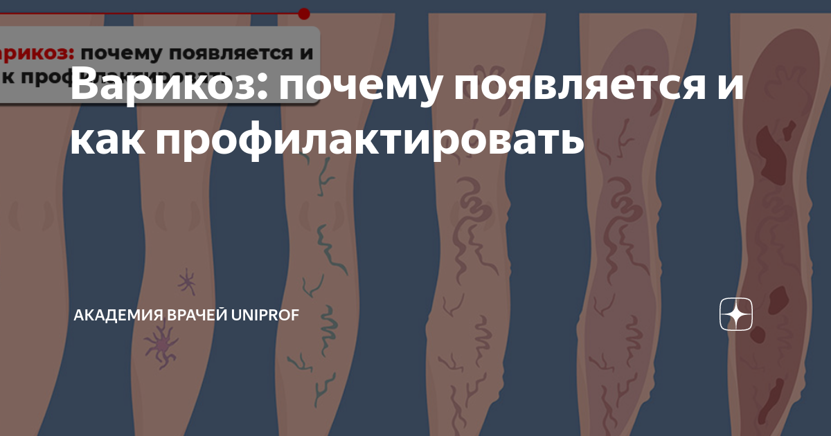 Варикоз: почему появляется и как профилактировать | Академия врачей ...