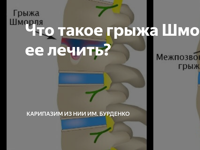 Грыжа шморля лечение Грыжа шморля лечение
