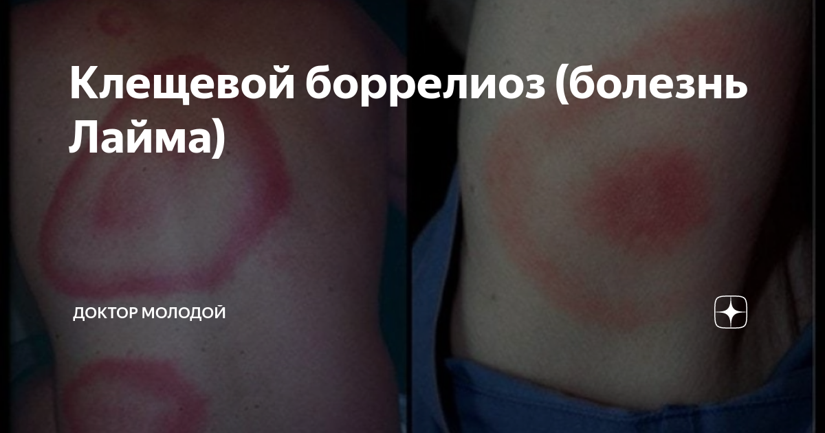 Клещевой боррелиоз (болезнь Лайма) | Доктор Молодой | Дзен