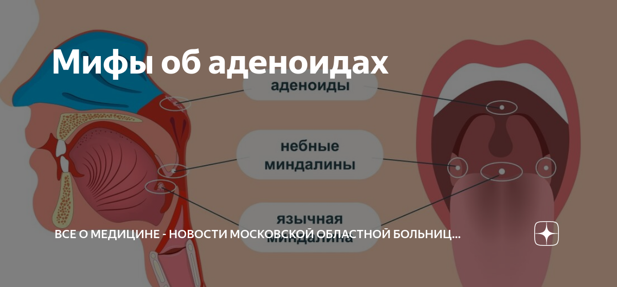 Аденоиды психосоматика у детей психосоматика. Аденоиды у ребенка психосоматика причины. Аденоиды у ребенка психосоматика причины. Аденоида причины аденоидов психосоматика. Строение носоглотки аденоиды.