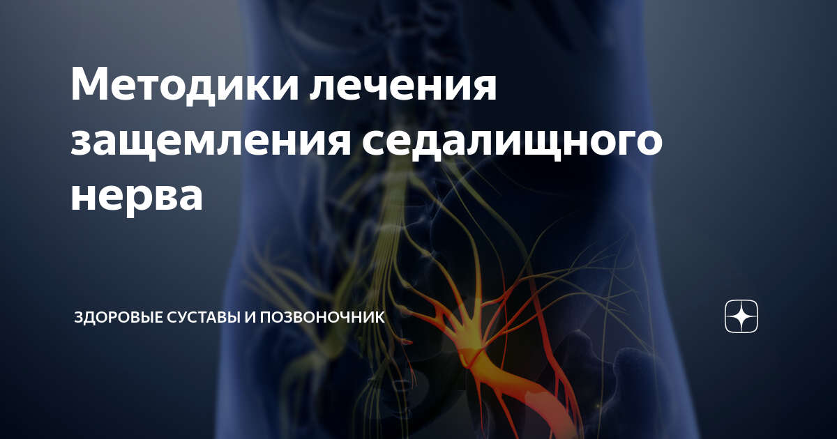 Защемление седалищного нерва при беременности 2 триместр. Защемление седалищного нерва при беременности 2 триместр