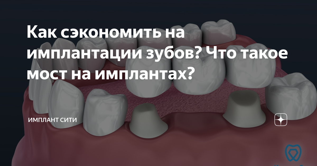 Как сэкономить на имплантации зубов? Что такое мост на имплантах ...