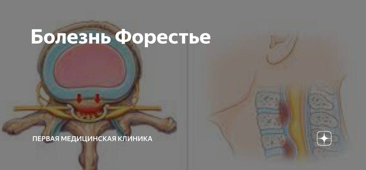 Болезнь Форестье | Первая Медицинская Клиника | Дзен