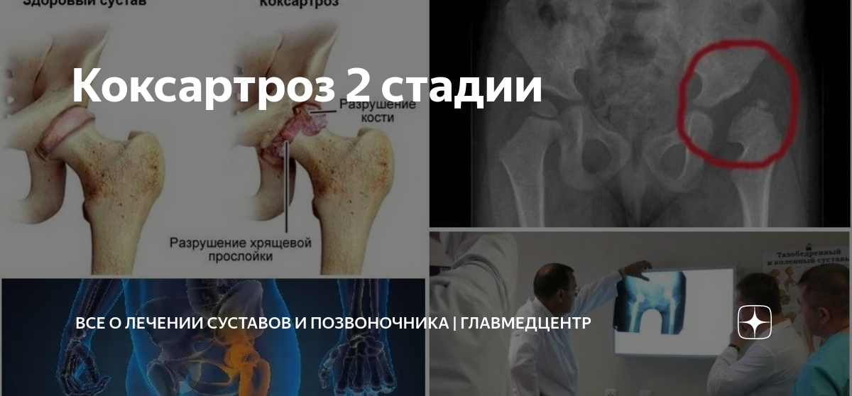 Коксартроз 2 стадии | Многопрофильная клиника в Санкт-Петербурге ...