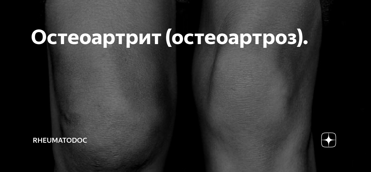 Остеоартрит (остеоартроз). | rheumatodoc | Дзен