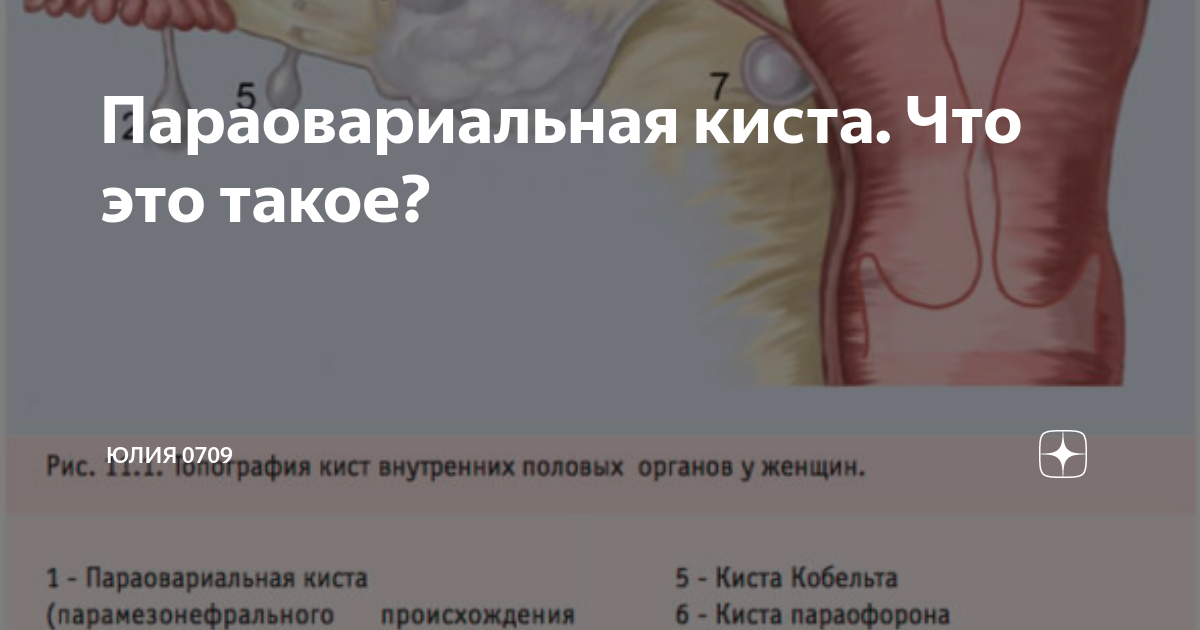 Параовариальная киста Параовариальная киста