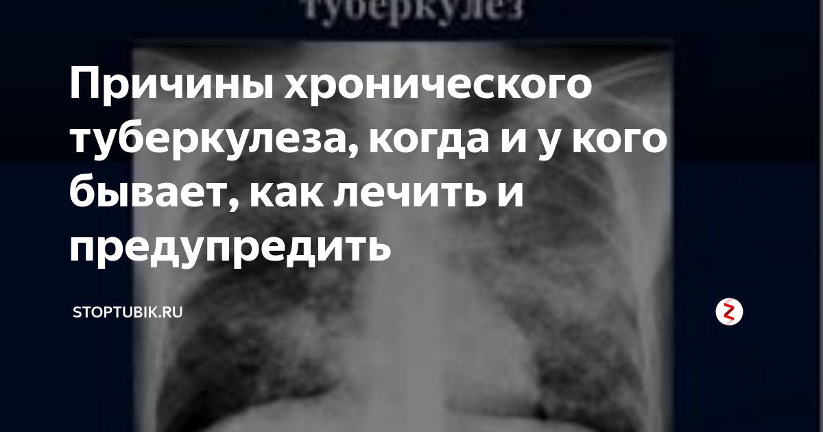 Туберкулез Легких Лечение Народными средствами – Удивительный Рецепт