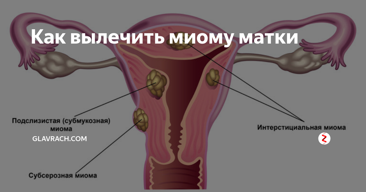 Структура миометрия неоднородная