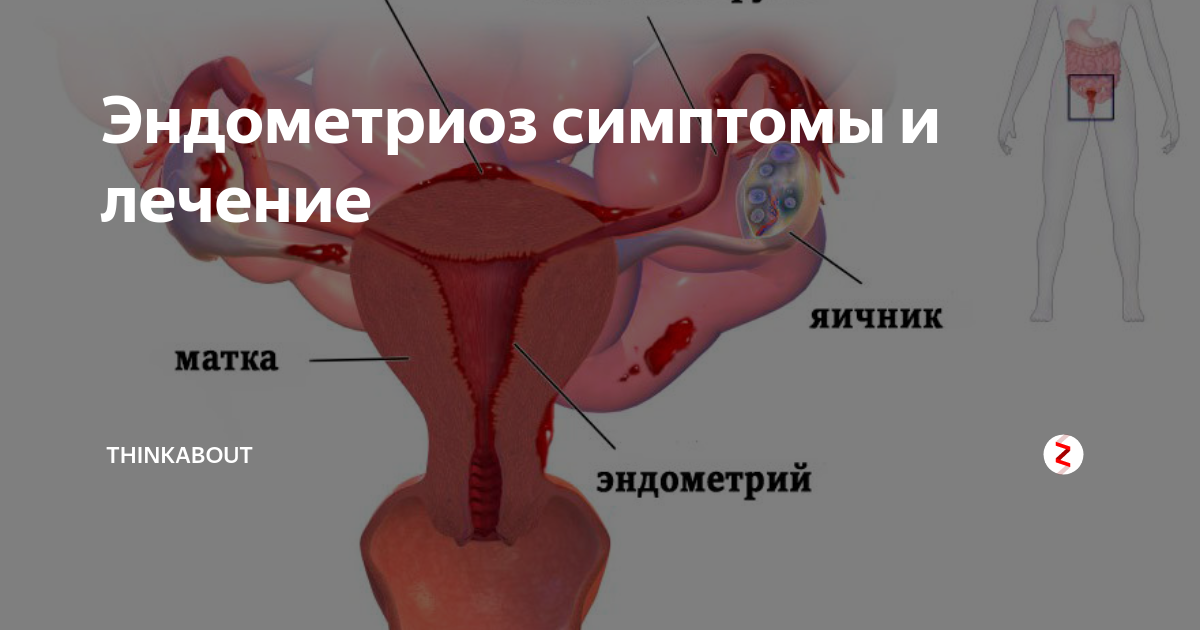 Эндометриоз менструация. Генитальный эндометриоз.