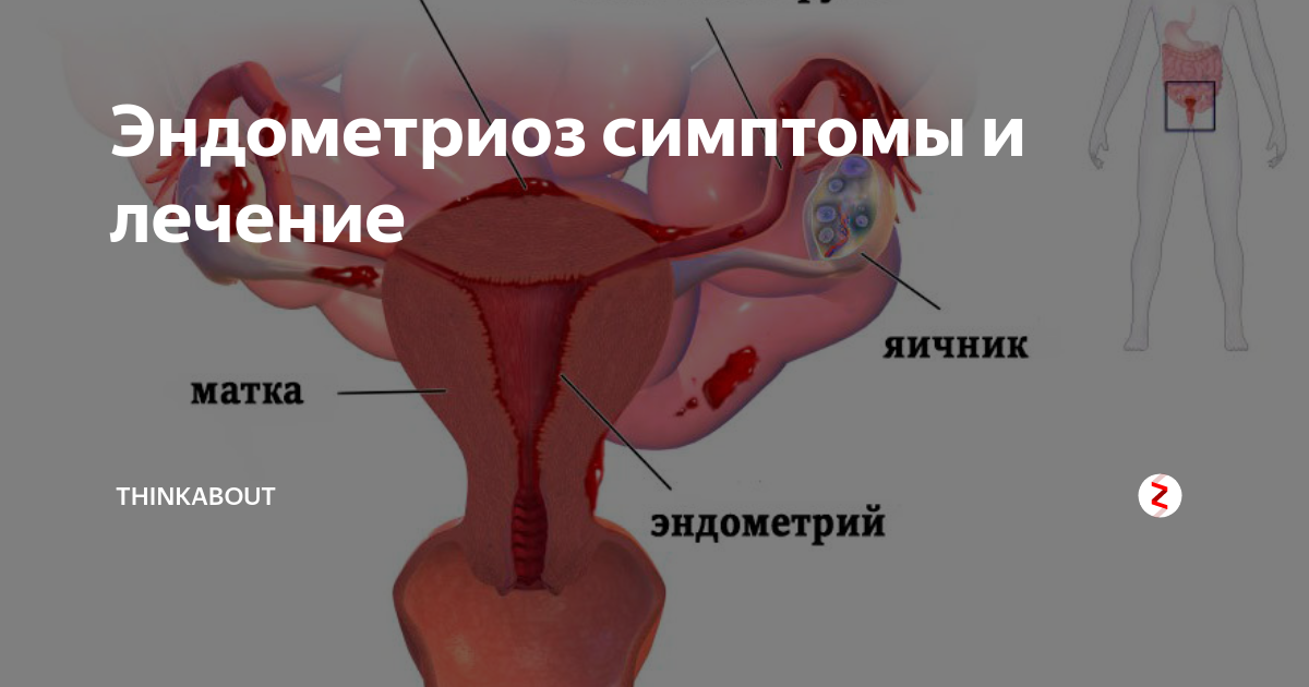 Эндометриоз матки это. Болезненные менструации. Эндометриоз. Эндометриоз и менструация. Эндометриоз матки симптомы.