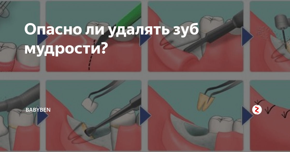 Удаление зуба мудрости как выглядит рана Применение материала "КоллапАн" при удалении зуба.avi YouTube