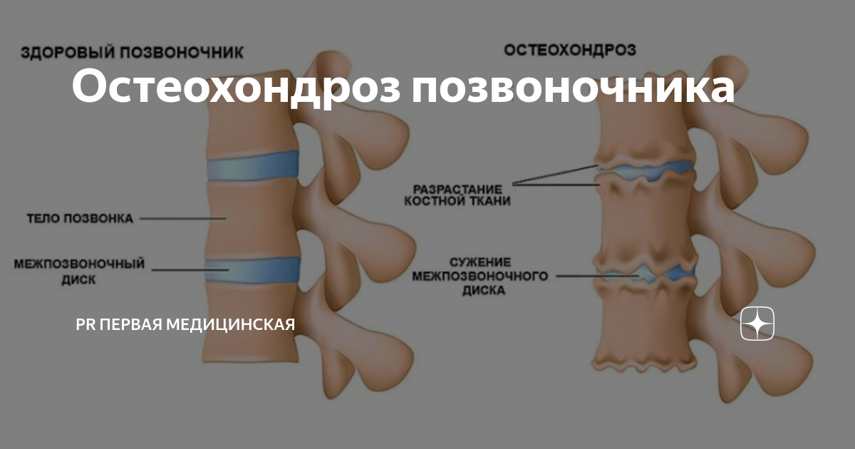 Остеохондроз позвоночника что это простыми словами. Остеохондроз позвоночника. Остеохондроз рекомендации. Остеохондроз позвоночника клинические рекомендации. М42.1 остеохондроз позвоночника.