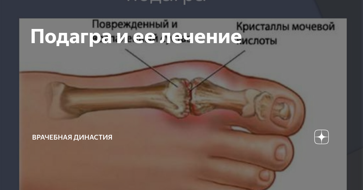 Подагра и ее лечение | Врачебная Династия | Дзен