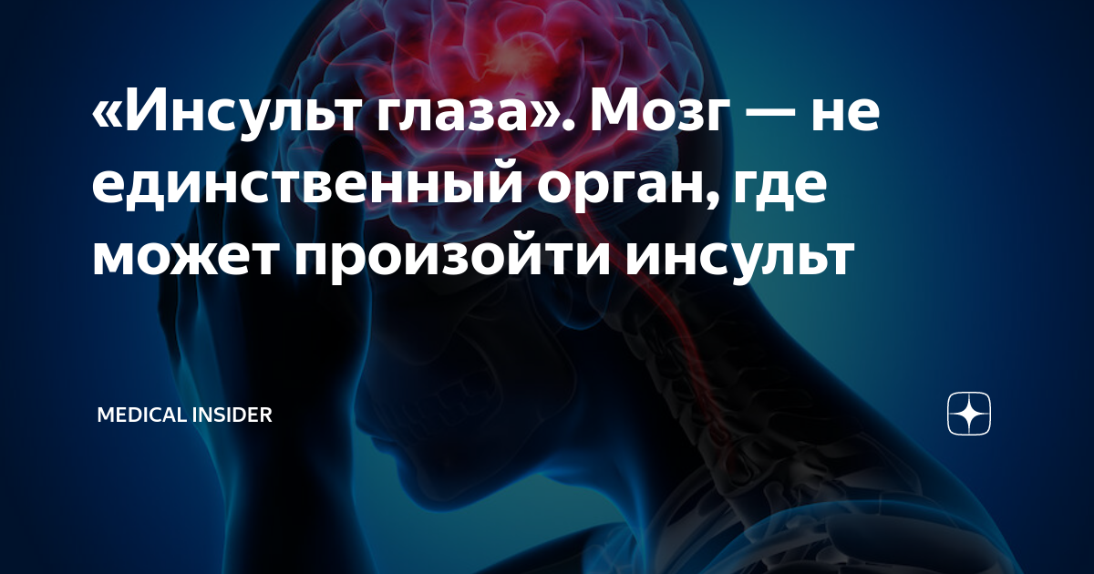 «Инсульт глаза». Мозг — не единственный орган, где может произойти ...