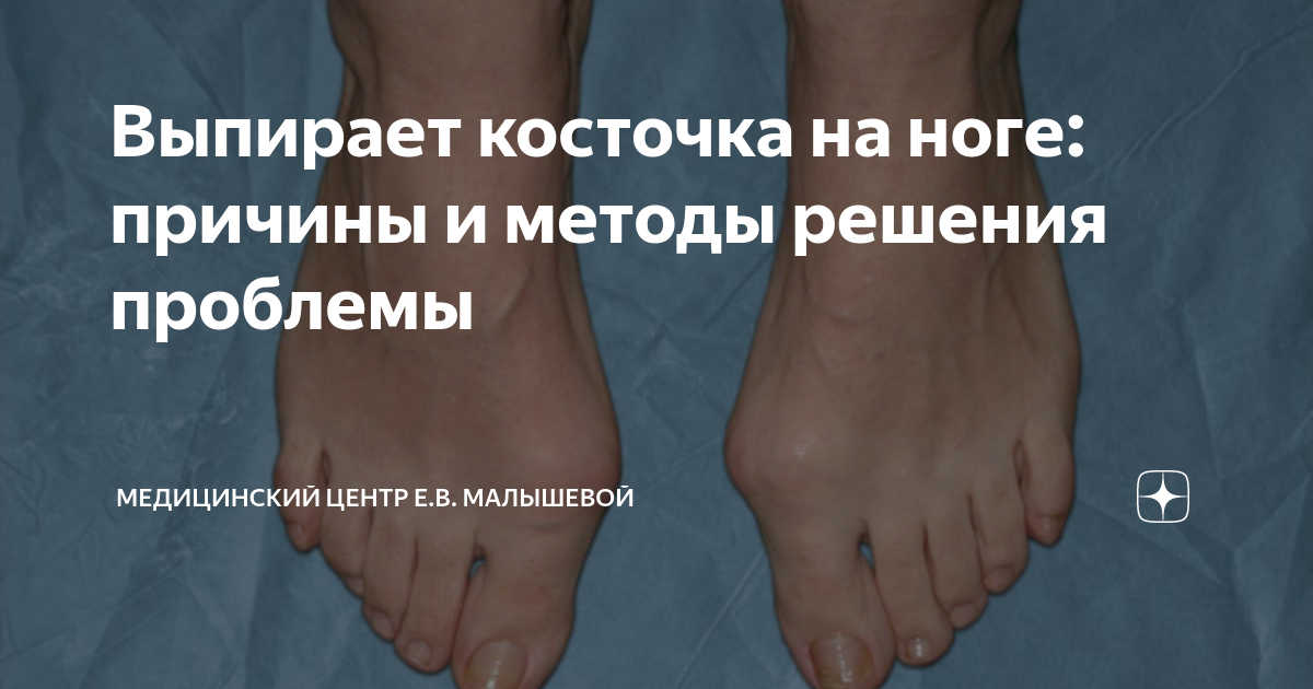 Выпирает косточка на ноге: причины и методы решения проблемы ...