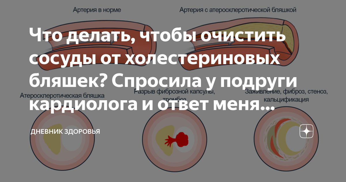 Чистка сосудов народными средствами в домашних условиях и их эффективность