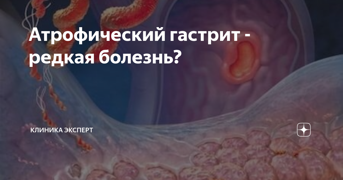 Атрофический гастрит - редкая болезнь? | Клиника ЭКСПЕРТ - Гастро ...