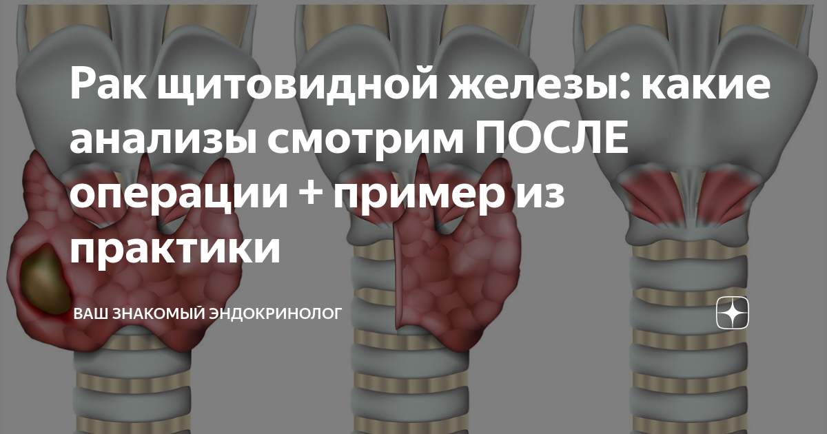 Рак щитовидной железы ▷ признаки, диагностика и лечение рака щитовидки ⚕ MedTour