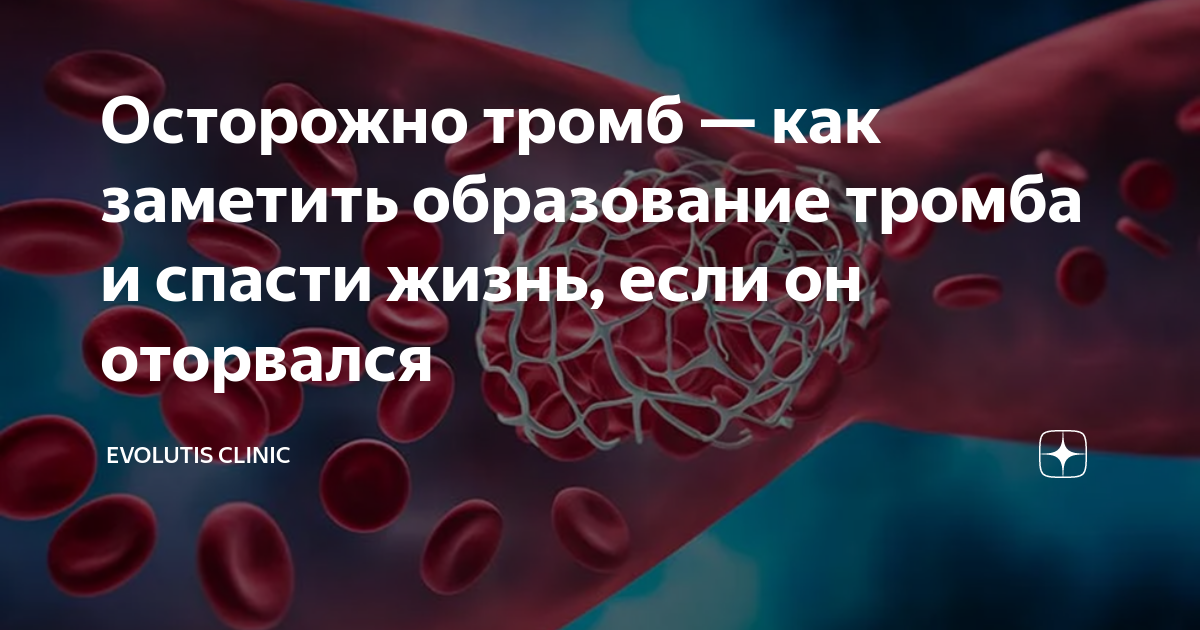 Осторожно тромб — как заметить образование тромба и спасти жизнь, если ...
